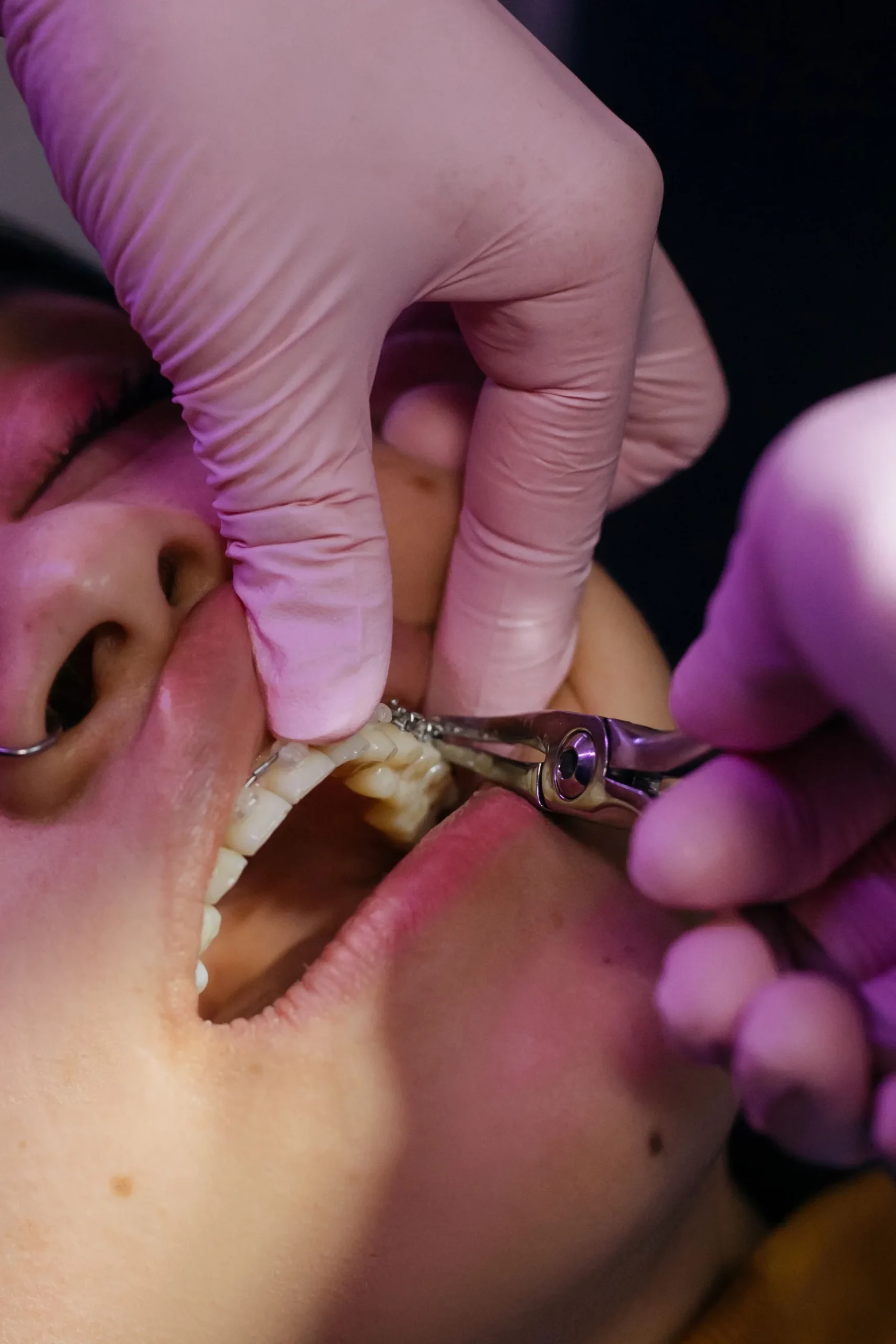 Dental Implants